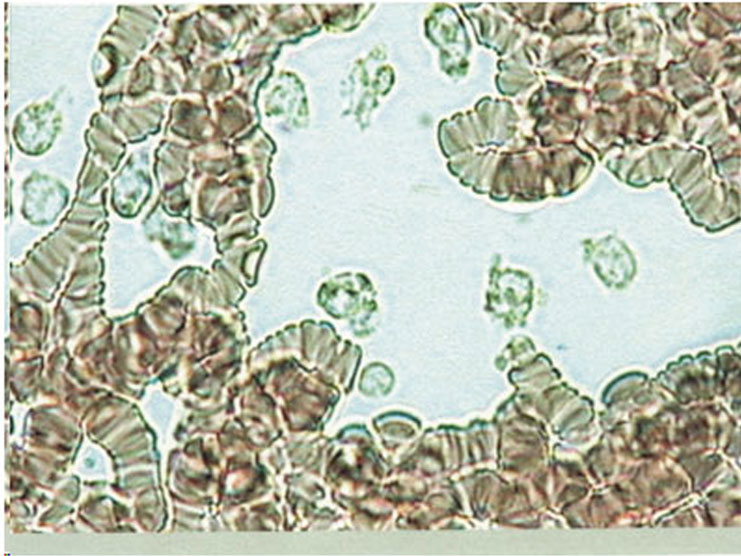 leucociti rigonfi